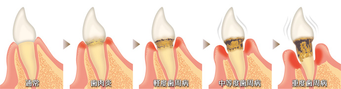 歯周病治療