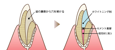 ウォーキングブリーチ